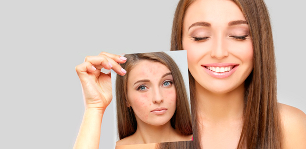 Лечение акне и постакне, фотодепигментация, фотоомоложение, удаление купероза и сосудистых звездочек IPL-аппаратом, а также лазерная эпиляция в студии Anti-Age. **Скидка до 90%**